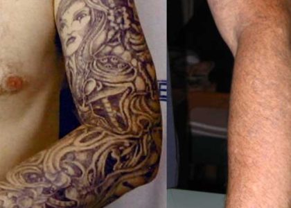 A New Tattoo Ink That Makes Removal Less Painful