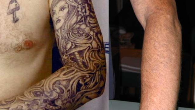 A New Tattoo Ink That Makes Removal Less Painful