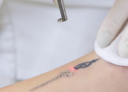 What Is Involved With Tattoo Getting Rid?