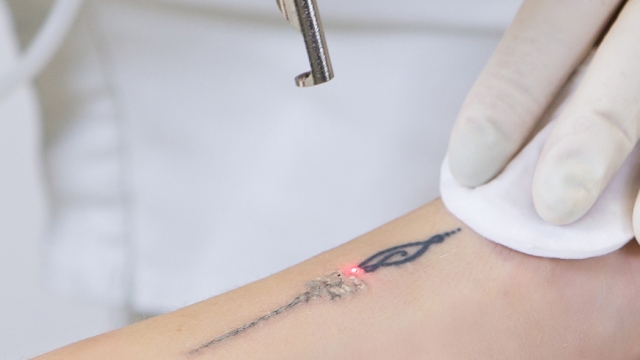 What Is Involved With Tattoo Getting Rid?