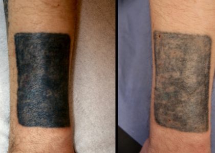 Safe Tattoo Removal For Females