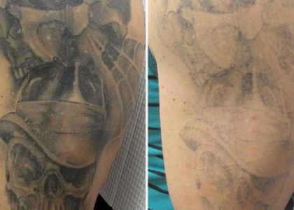 The Advantages Of Laser Tattoo Removal