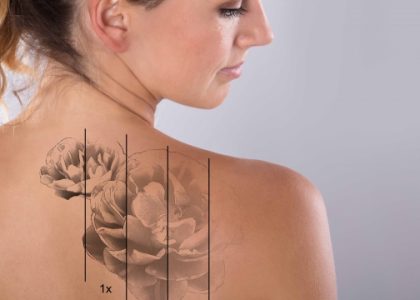 Want Realize More About Tattoo Eliminating?